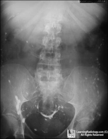 Perforated rectum